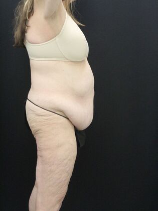 Tummy Tuck: Case 87 - Before