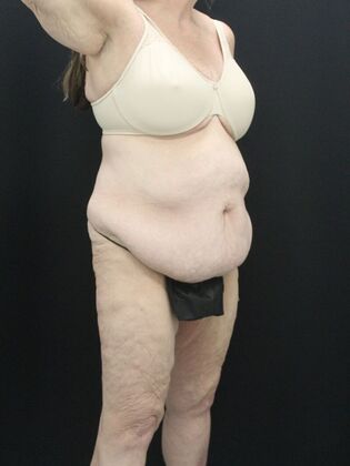 Tummy Tuck: Case 87 - Before