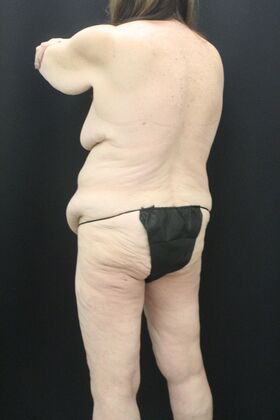 Tummy Tuck: Case 87 - Before