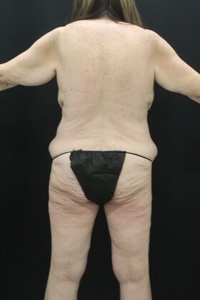 Tummy Tuck: Case 87 - Before