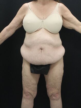 Tummy Tuck: Case 87 - Before