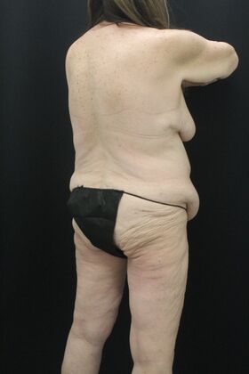 Tummy Tuck: Case 87 - Before