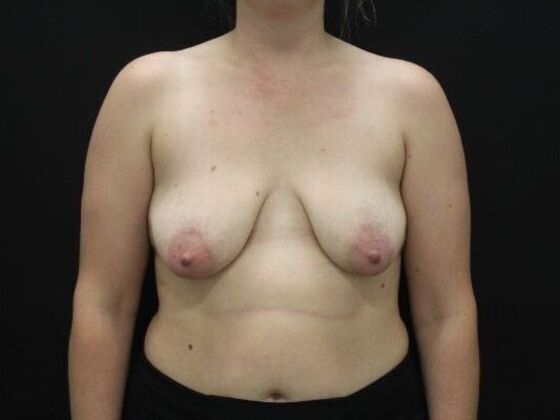 Breast Lift/Breast Lift Augmentation: Case 72 - Before