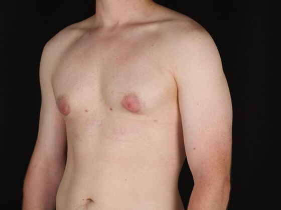Gynecomastia & Male Breast Reduction: Case 5 - After