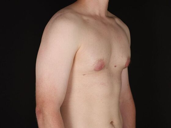 Gynecomastia & Male Breast Reduction: Case 5 - After