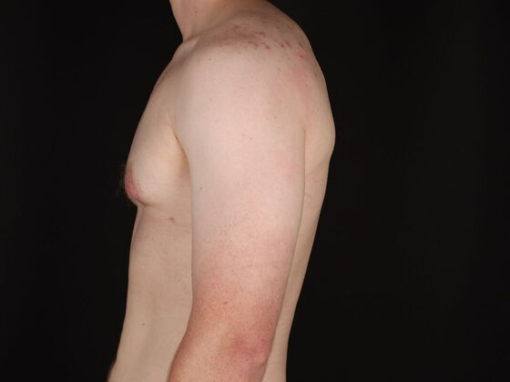 Gynecomastia & Male Breast Reduction: Case 5 - After