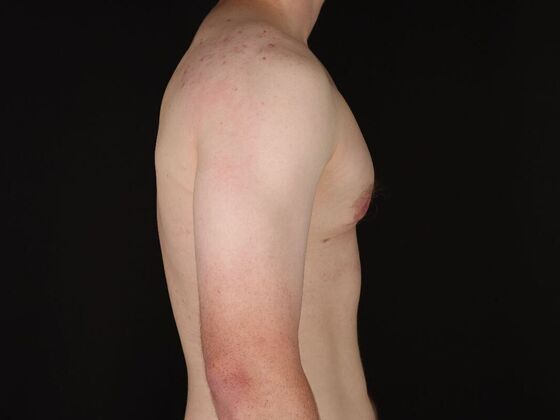 Gynecomastia & Male Breast Reduction: Case 5 - After