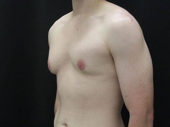 Gynecomastia & Male Breast Reduction: Case 5 - Before