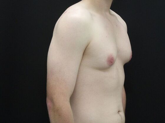 Gynecomastia & Male Breast Reduction: Case 5 - Before