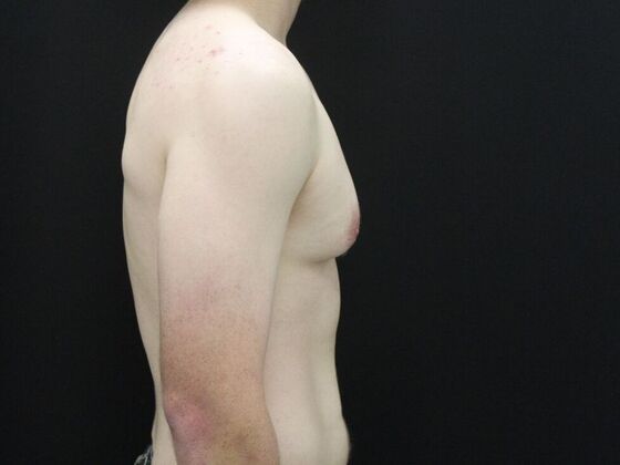 Gynecomastia & Male Breast Reduction: Case 5 - Before
