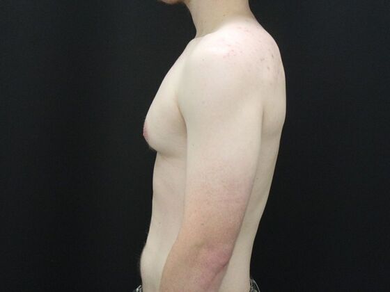 Gynecomastia & Male Breast Reduction: Case 5 - Before