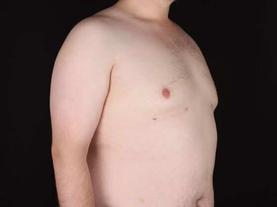 Gynecomastia & Male Breast Reduction: Case 6 - After