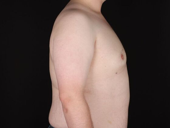 Gynecomastia & Male Breast Reduction: Case 6 - After