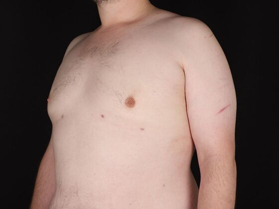 Gynecomastia & Male Breast Reduction: Case 6 - After