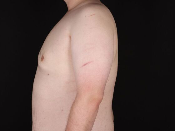Gynecomastia & Male Breast Reduction: Case 6 - After