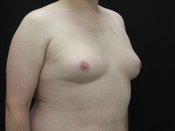 Gynecomastia & Male Breast Reduction: Case 6 - Before