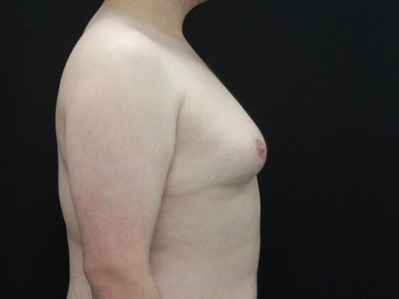 Gynecomastia & Male Breast Reduction: Case 6 - Before