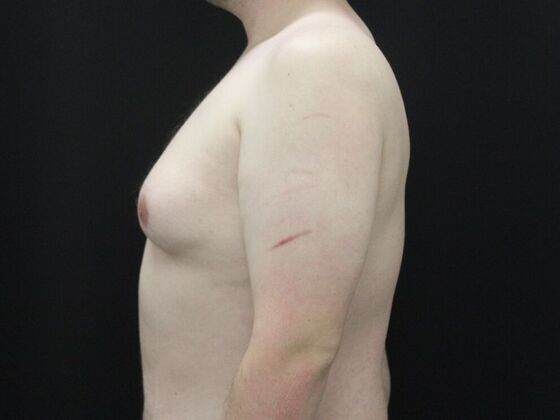 Gynecomastia & Male Breast Reduction: Case 6 - Before