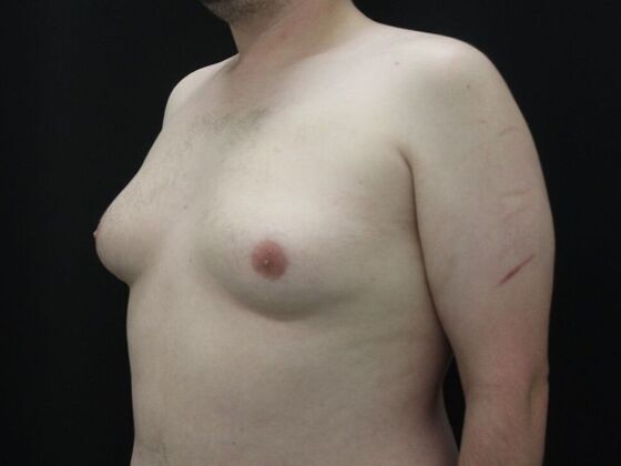 Gynecomastia & Male Breast Reduction: Case 6 - Before