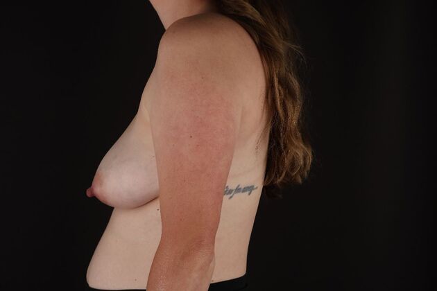 Breast Lift & Breast Lift Augmentation: Case 74 - Before