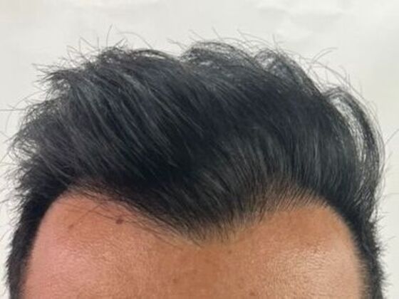 FUE Hair Restoration: Case 51 - After