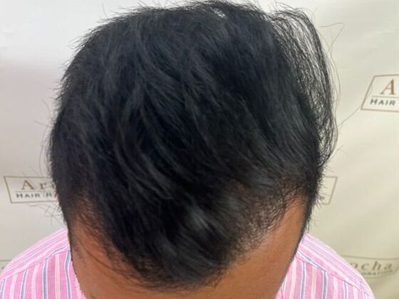 FUE Hair Restoration: Case 51 - After