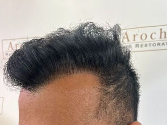 FUE Hair Restoration: Case 51 - After