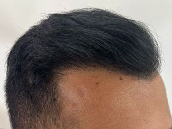 FUE Hair Restoration: Case 51 - After