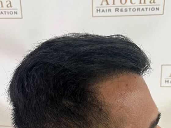 FUE Hair Restoration: Case 51 - After