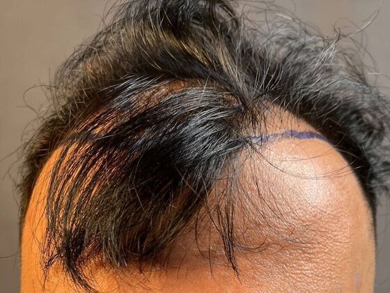 FUE Hair Restoration: Case 51 - Before
