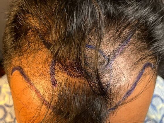 FUE Hair Restoration: Case 51 - Before