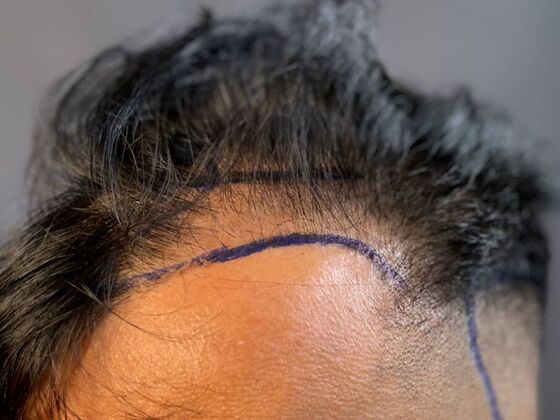 FUE Hair Restoration: Case 51 - Before