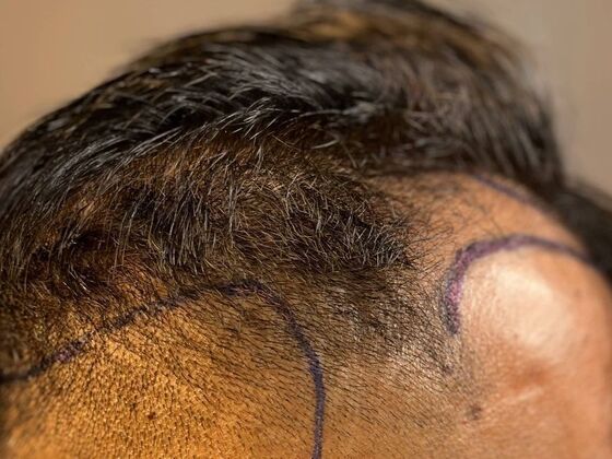 FUE Hair Restoration: Case 51 - Before