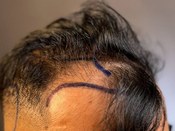 FUE Hair Restoration: Case 51 - Before