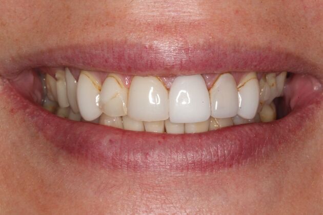 Full Mouth Reconstruction: Alex - Before