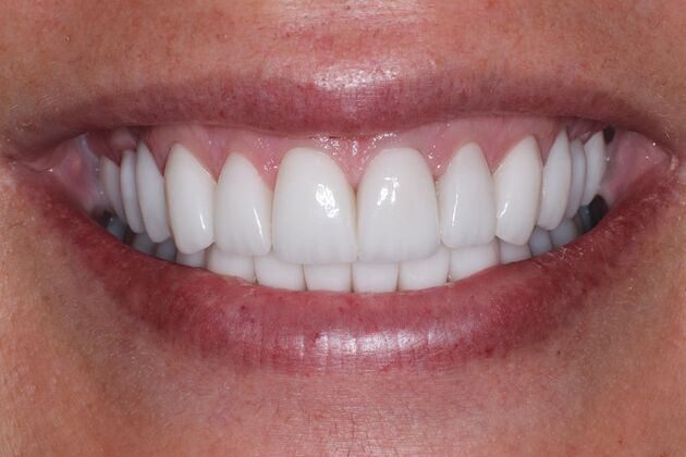 Full Mouth Reconstruction: Alex - After