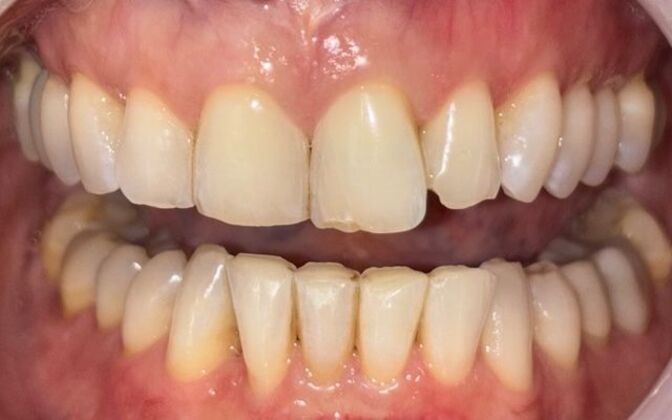 Dental Crowns Case 1 - Before