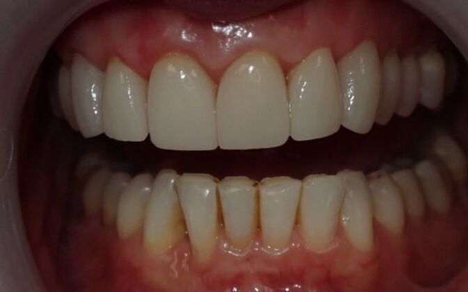 Dental Crowns Case 1 - After