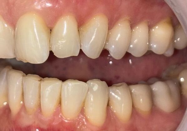 Dental Crowns: Case 1 - Before