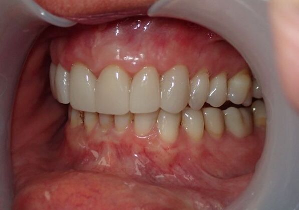 Dental Crowns: Case 1 - After