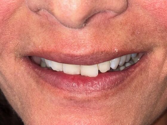 Dental Crowns: Case 1 - Before