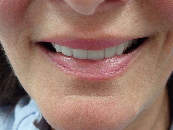 Dental Crowns: Case 1 - After