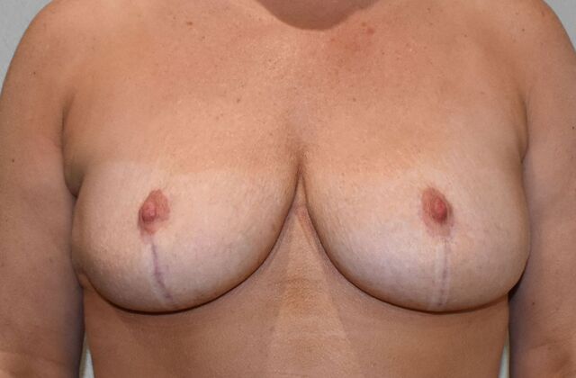 Breast Reduction: Case 1 - After