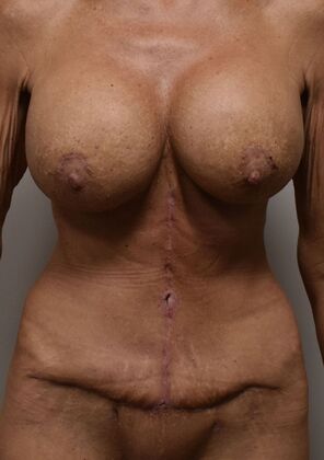 Mommy Makeover Case 377 - After