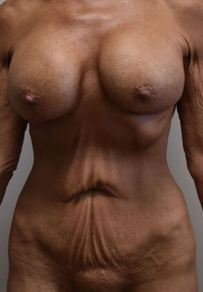 Mommy Makeover: Case 377 - Before
