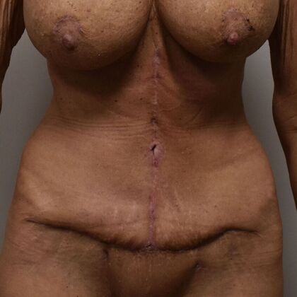 Tummy Tuck (Abdominoplasty): Case 590 - After