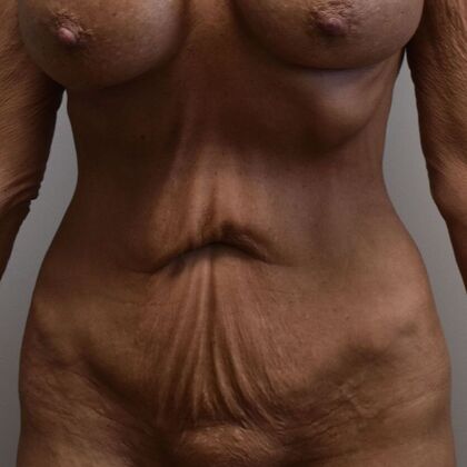 Tummy Tuck (Abdominoplasty): Case 590 - Before