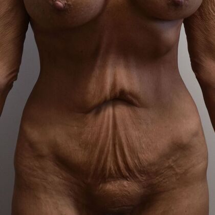 Tummy Tuck (Abdominoplasty): Case 590 - Before