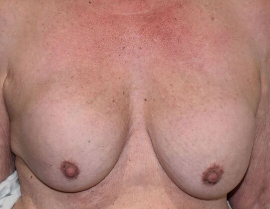 Breast Revision Case 20 - Before