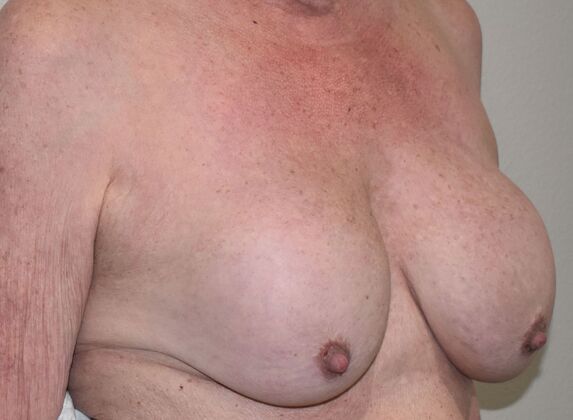 Breast Revision: Case 20 - Before